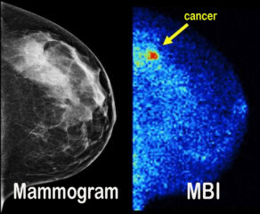 Mammogram vs. MBI