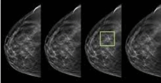 3D mammogram slices