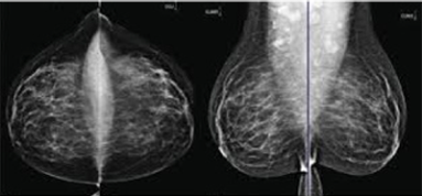 conventional mammography