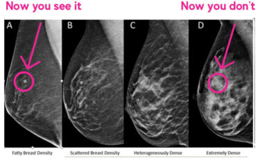 Breast Categories ABCD