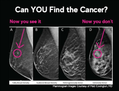 ¿Puedes encontrar el cáncer?