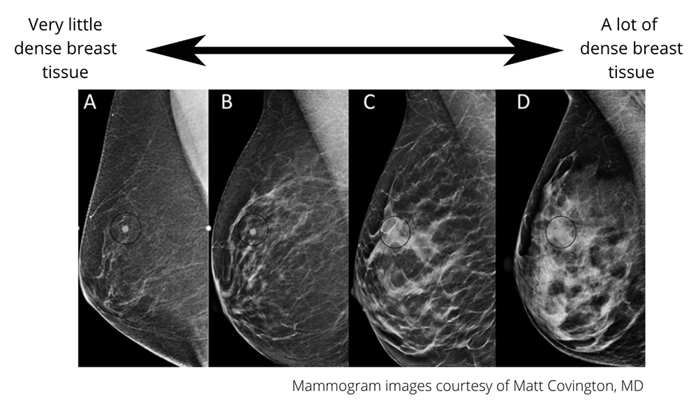 Breast Density example by Matt Covington